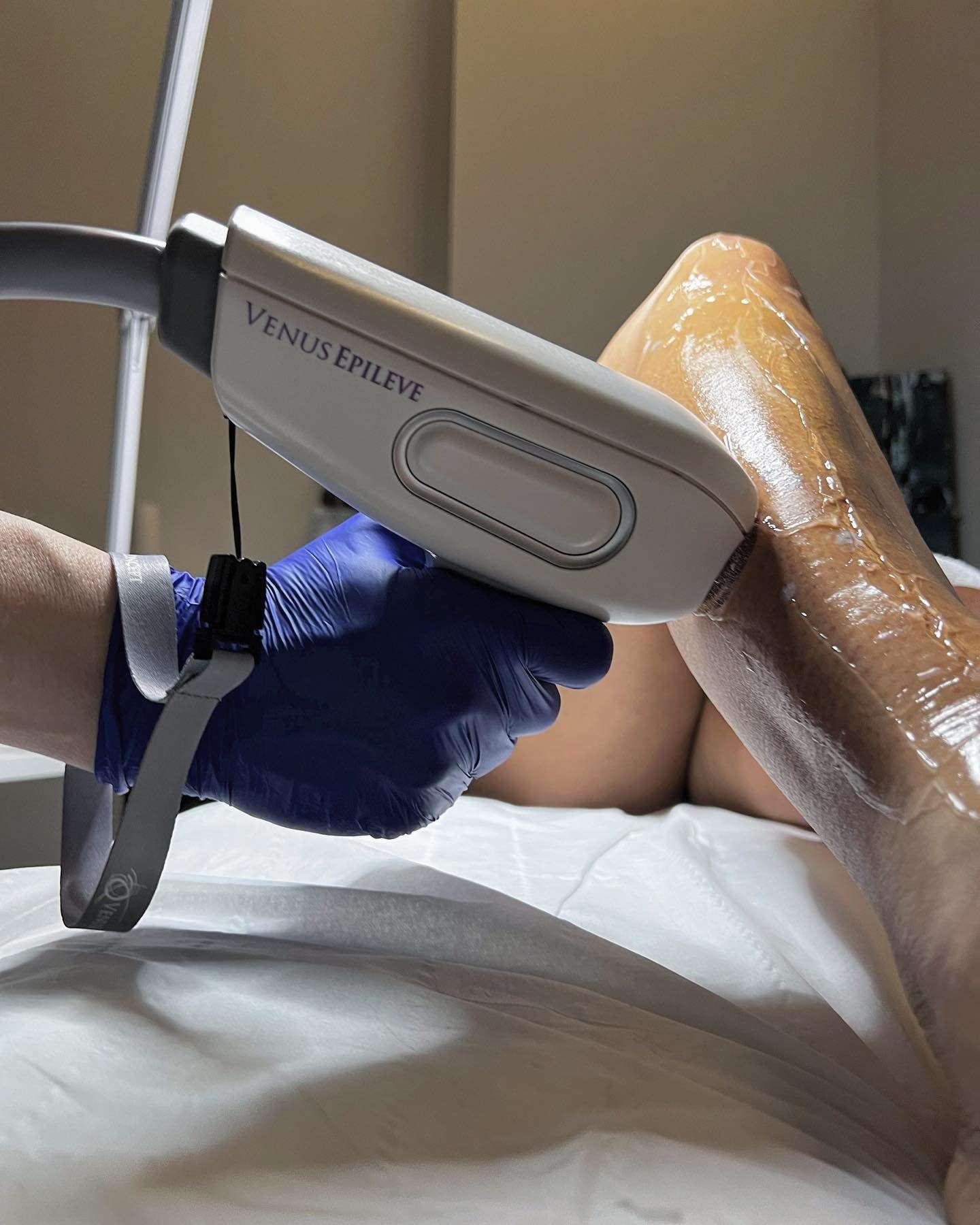 Close-up of a person's leg covered in a gel or wax being treated with a Venus Epileve laser hair removal device held by a gloved hand.